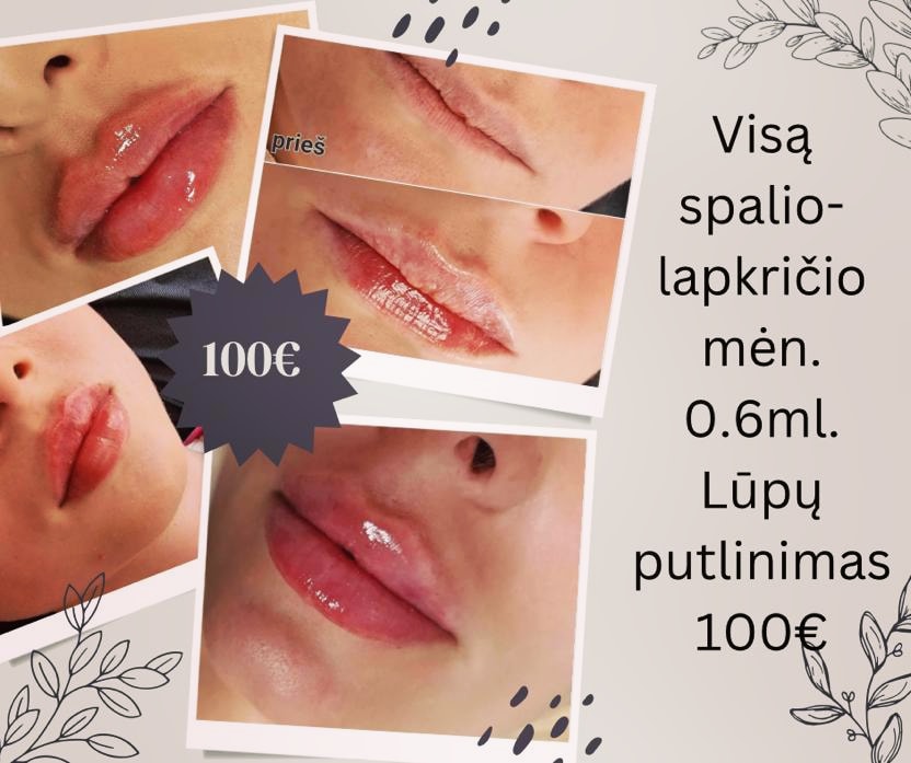 Lūpų putlinimas